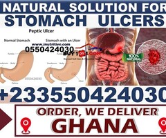 Natural Remedy for Stomach Ulcer in Kumasi